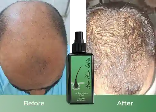Before and after using Neo Hair Lotion - significant hair regrowth Before and after using Neo Hair Lotion - significant hair regrowth