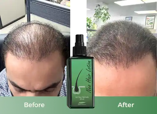 Before and after using Neo Hair Lotion - significant hair regrowth Before and after using Neo Hair Lotion - significant hair regrowth