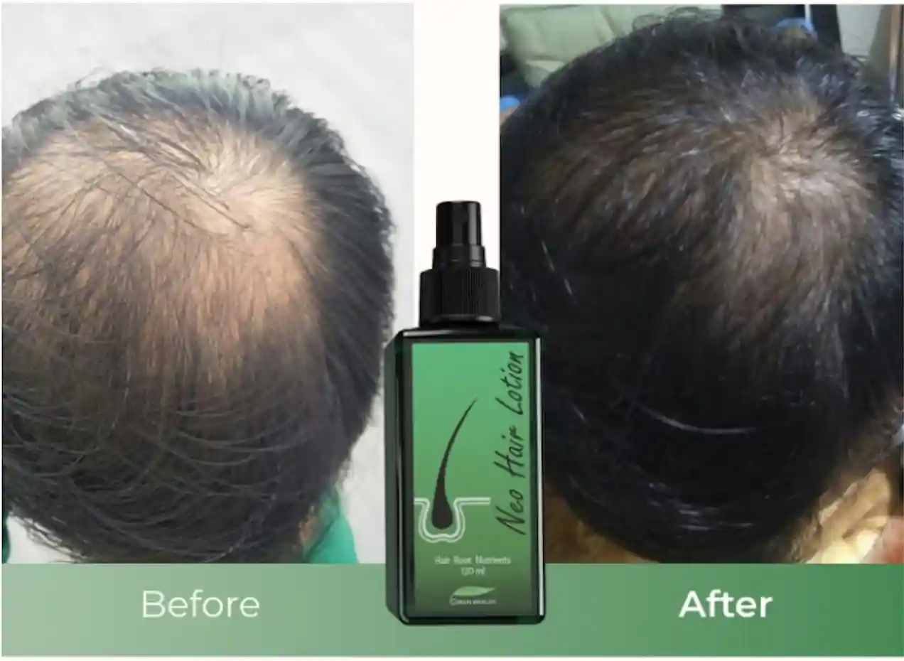 Before and Afret image neo hair lotion