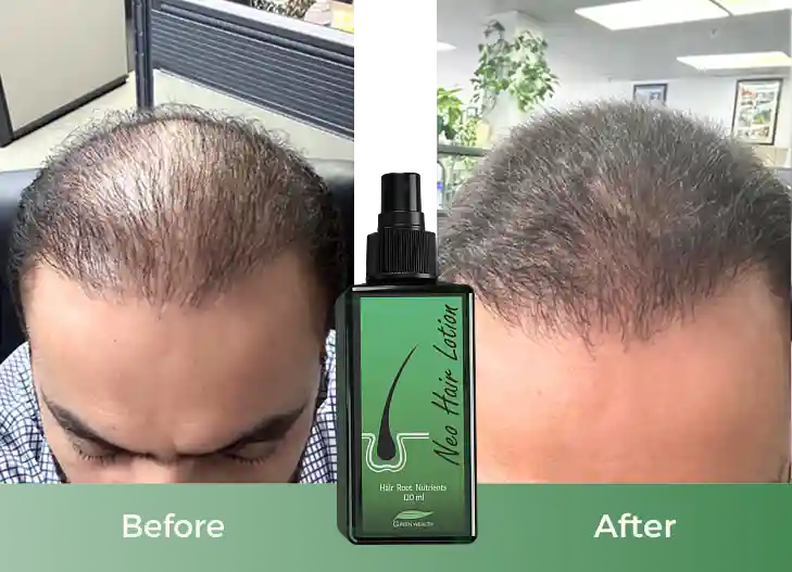 Before and Afret image neo hair lotion