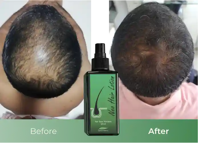 Before and Afret image neo hair lotion